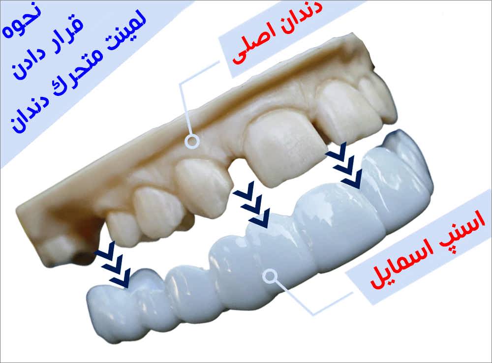 نحوه قرار دادن لمینت متحرک دندان داروخانه